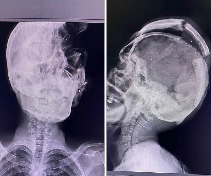 X-ray images showing unusual medical conditions affecting the skull and cervical spine in diagnostic medical photos.