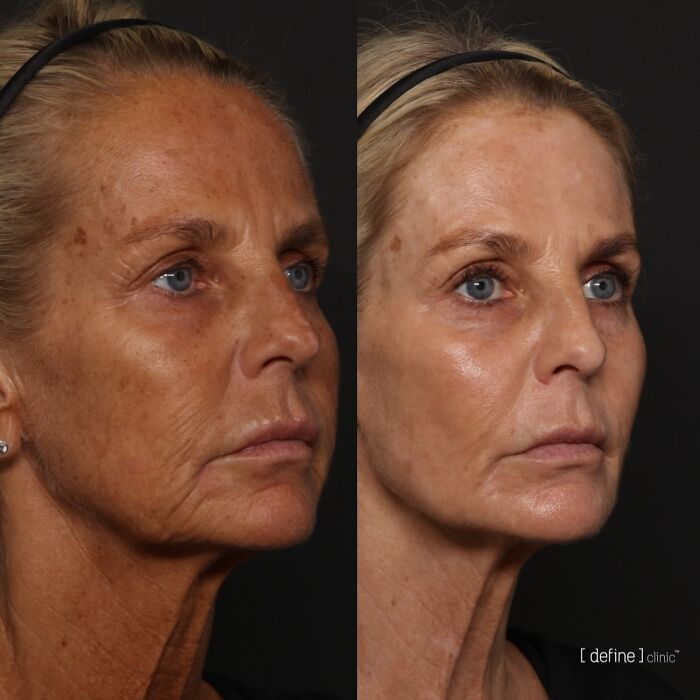 Ulrika Jonsson, 58, revela os seis meses de tratamento por trás de sua transformação dramática Ulrika Jonsson, 58, revela os seis meses de tratamento por trás de sua transformação dramática