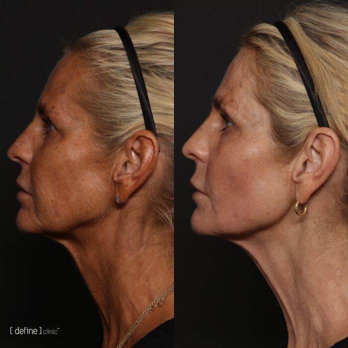 Ulrika Jonsson, 58, revela os seis meses de tratamento por trás de sua transformação dramática Ulrika Jonsson, 58, revela os seis meses de tratamento por trás de sua transformação dramática