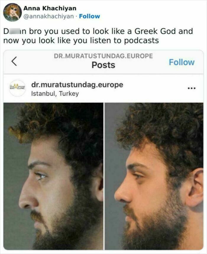 Before and after profile photos showing a man's nose transformation, one of 97 unhinged sentences images that leave everyone speechless.