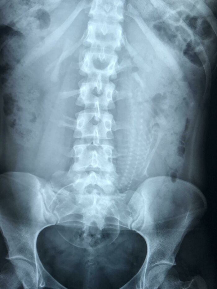 X-ray image of human spine and pelvis revealing unusual details that freak people out about their own bodies.