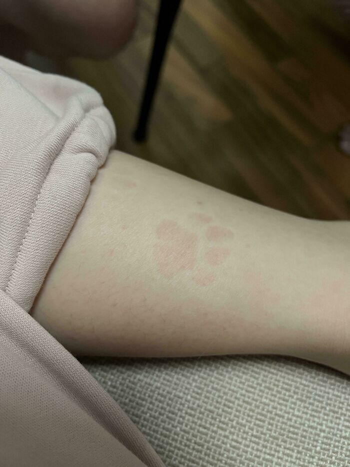 Mildly interesting pictures of a paw print rash on a person's arm, making you say huh.