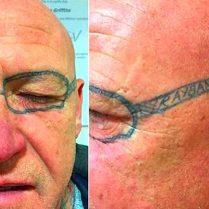 Tattoo of eyeglasses drawn around eyes on bald head