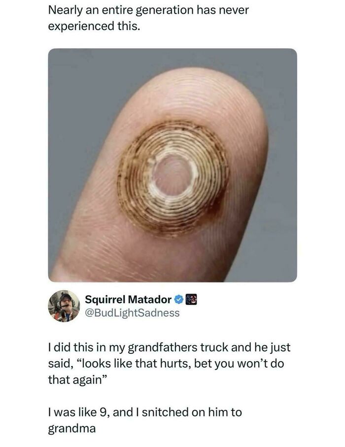 Finger with circular burn mark and social media text, a kid did something dumb and funny.