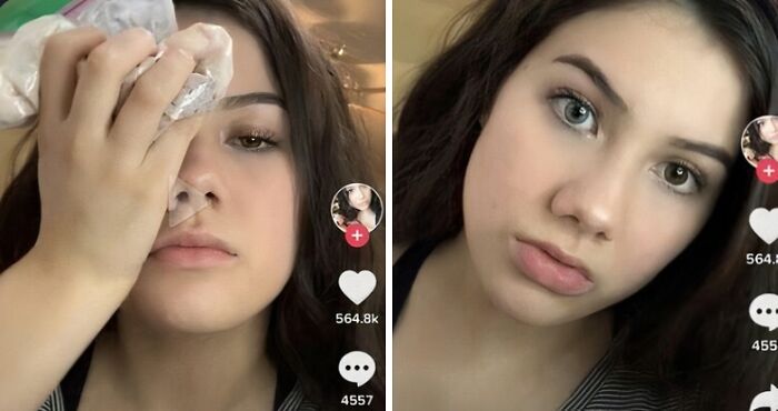 Young influencer using ice pack on eye in a TikTok video showing cringy influencer behavior and rule-breaking actions