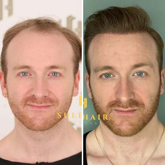 Before and after hair transplant results showing improved hair density and fuller hairline on a man's scalp.