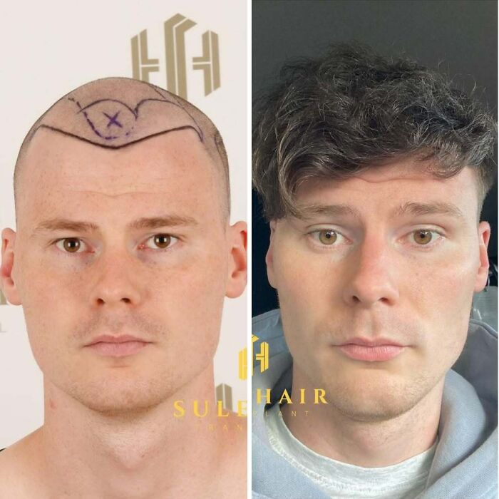 Before and after images of a man showing the impact of a hair transplant procedure on hair restoration.