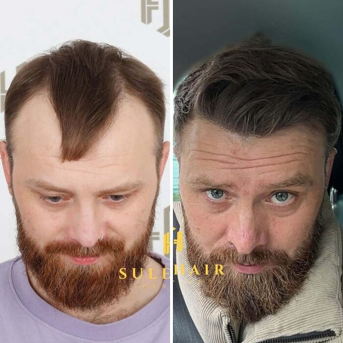 Before and after hair transplant results showing improved hair density and coverage in a man with a beard.