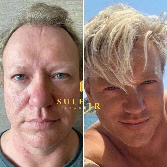 Before and after images of a man showcasing results from a hair transplant with improved hair density and style.