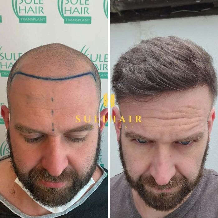 Before and after hair transplant photos showing the transformation of hair restoration results on a male patient.