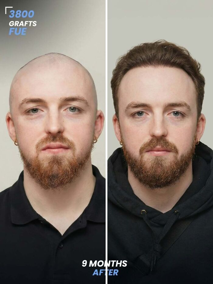 Before and after hair transplant photos showing results with 3800 FUE grafts after 9 months on a male patient.