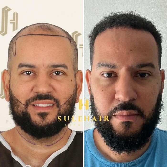 Before and after hair transplant photos showing restored hairline and increased hair density on a man's scalp and beard area.