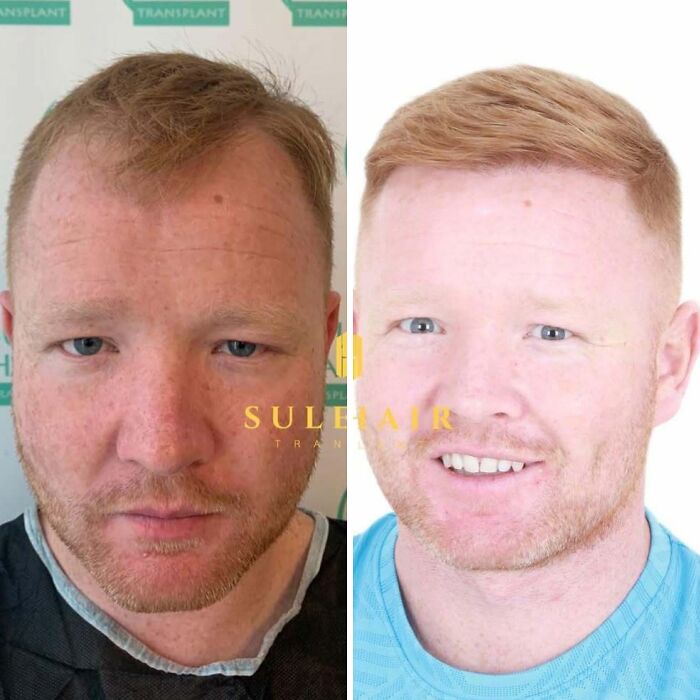 Before and after photos showing hair transplant results on a man with improved hair density and hairline restoration.