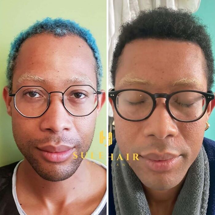 Before and after hair transplant photos showing improved hair density and natural hairline restoration on a man wearing glasses.