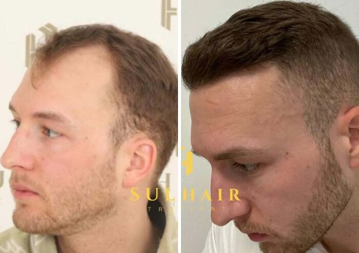 Before and after hair transplant photos showing improved hair density and natural hairline restoration results.