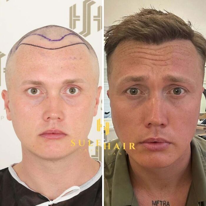 Before and after hair transplant photos showing significant hair restoration on a man’s scalp and hairline.