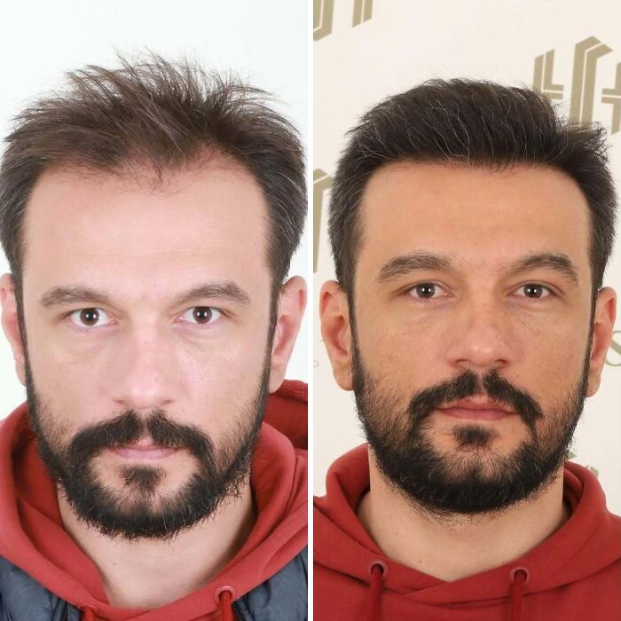 Before and after hair transplant photos showing noticeable improvement in hair density and hairline restoration.