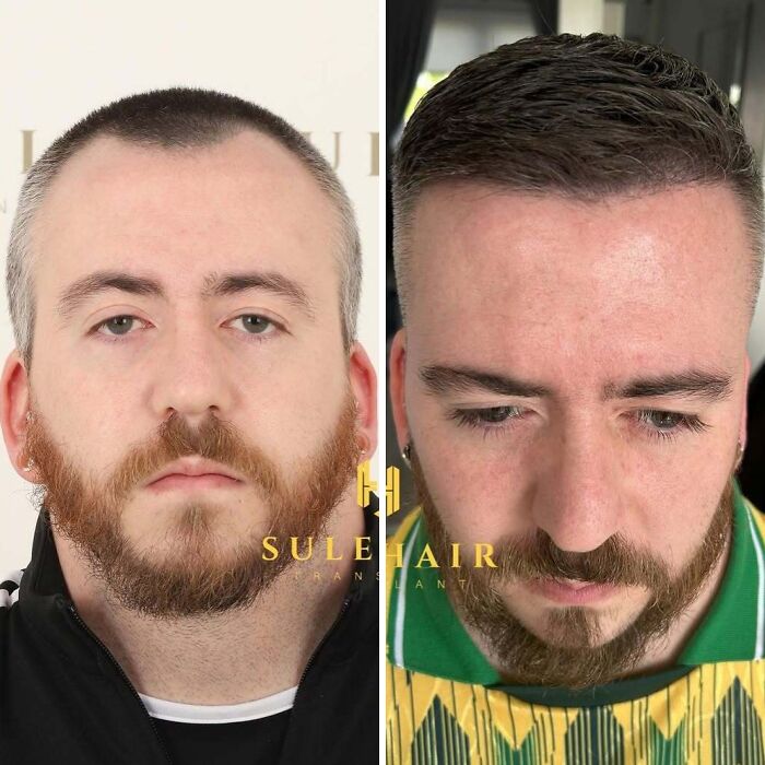 Before and after hair transplant results showing improved hair density and hairline restoration on a man's scalp.