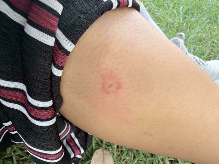 A baffling image of a leg with a circular red mark, prompting questions that the internet might answer.