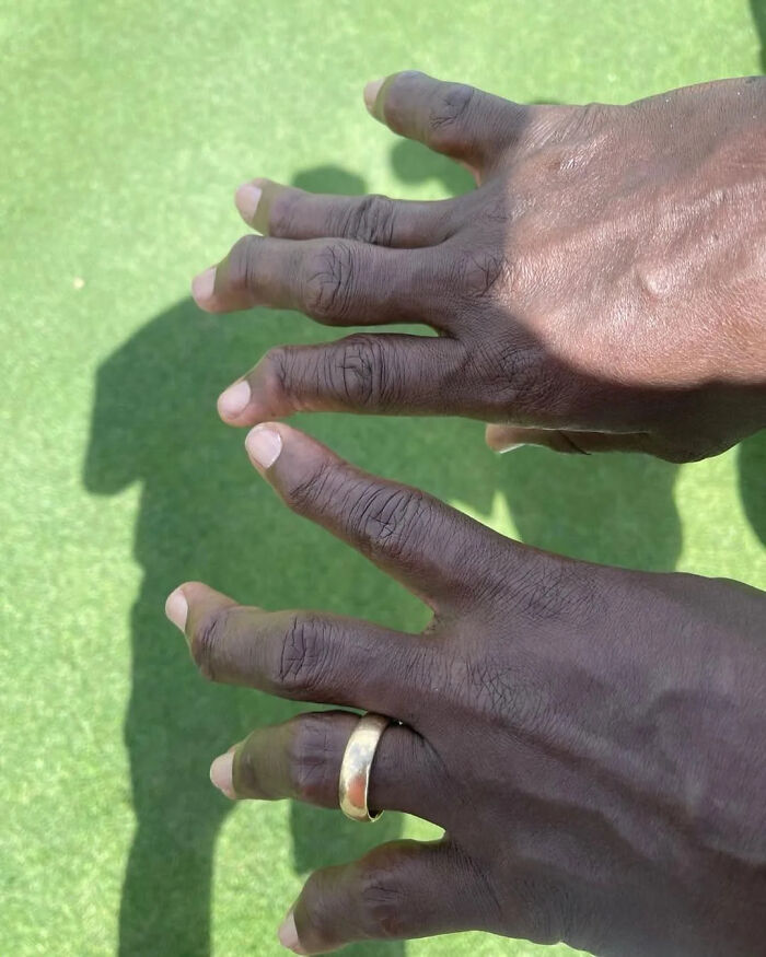 Two hands with incredibly long fingers and a gold ring on one, casting shadows on green ground, an interesting photo.