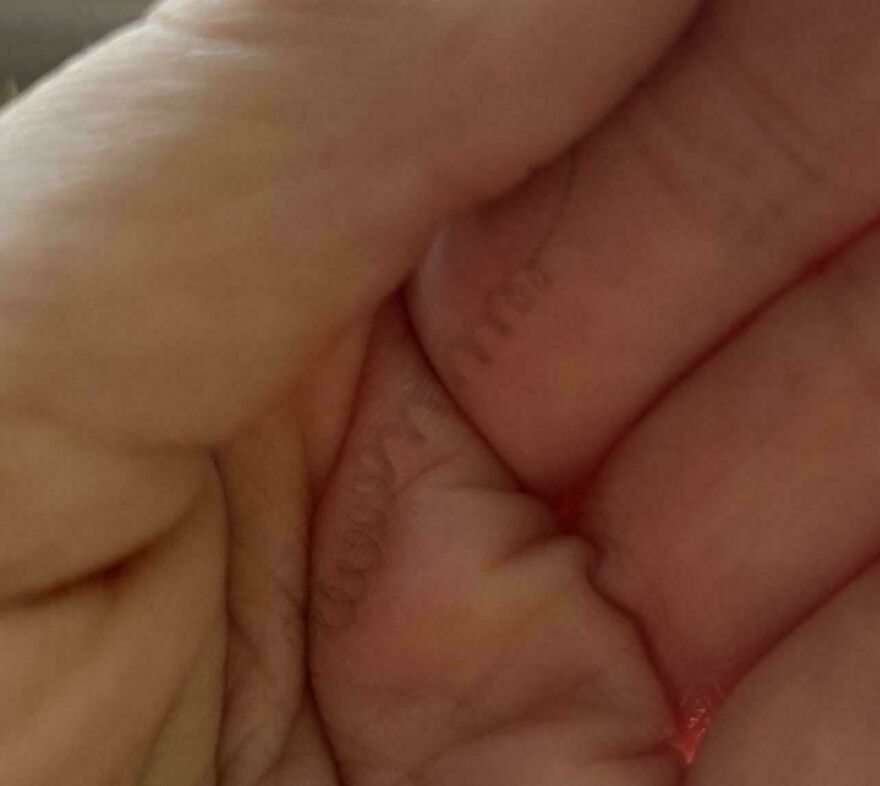 Close-up of a hand showing a small, unexplainable red mark, one of the weird things people experienced.