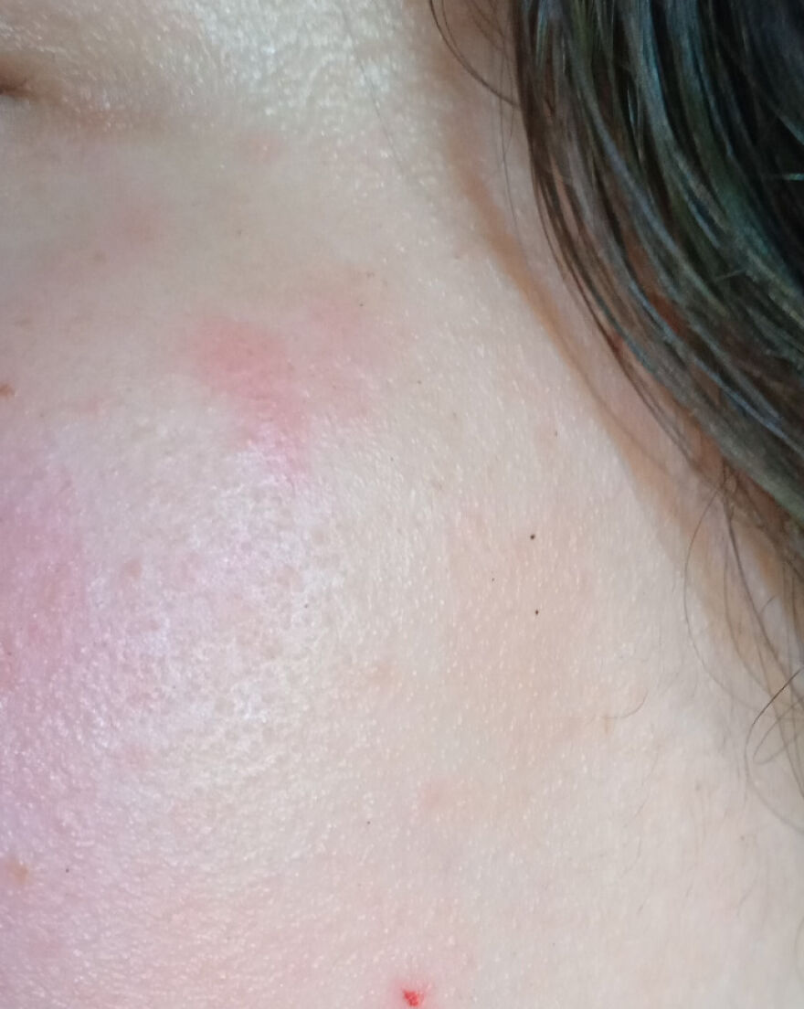 Close-up of skin with a red, swollen patch showing a weird and unexplainable skin reaction experienced by a person.