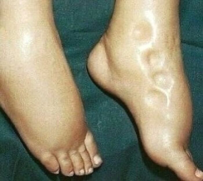 Close-up of swollen feet with visible veins and skin discoloration, illustrating a medical condition caution image.