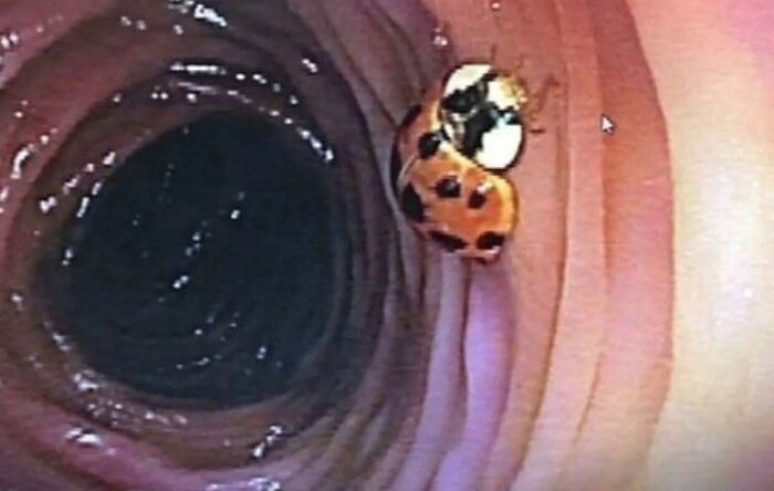 Close-up of a ladybug inside a human intestinal tract showing an unusual medical image for green hairy tongue keyword context.