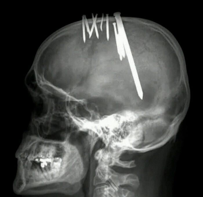 X-ray of a skull showing multiple nails embedded in the head, illustrating a severe medical emergency case.