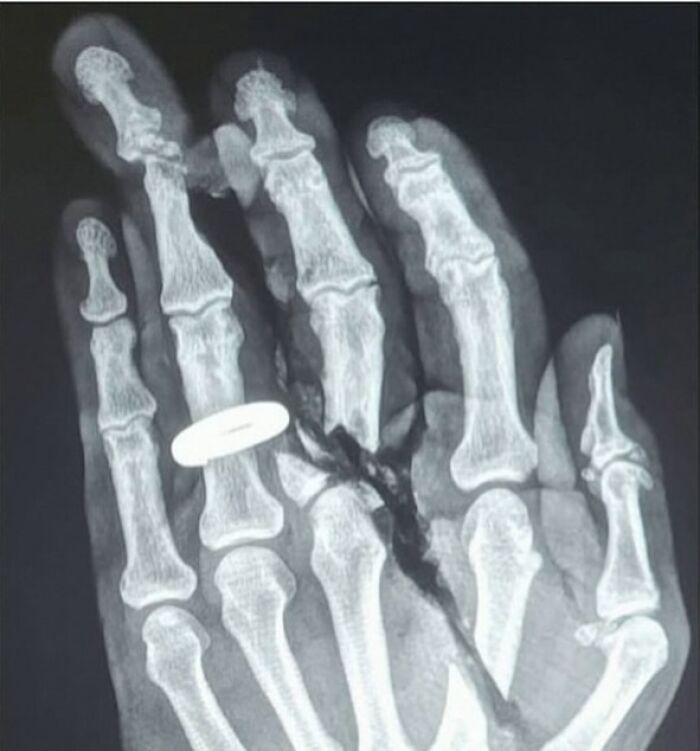 X-ray image of a hand showing detailed bone structure and a ring on one finger, medical imagery caution.