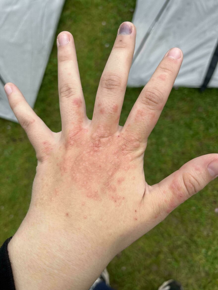 Human hand with red rash spots, showing weird and unexplainable skin condition experienced outdoors.