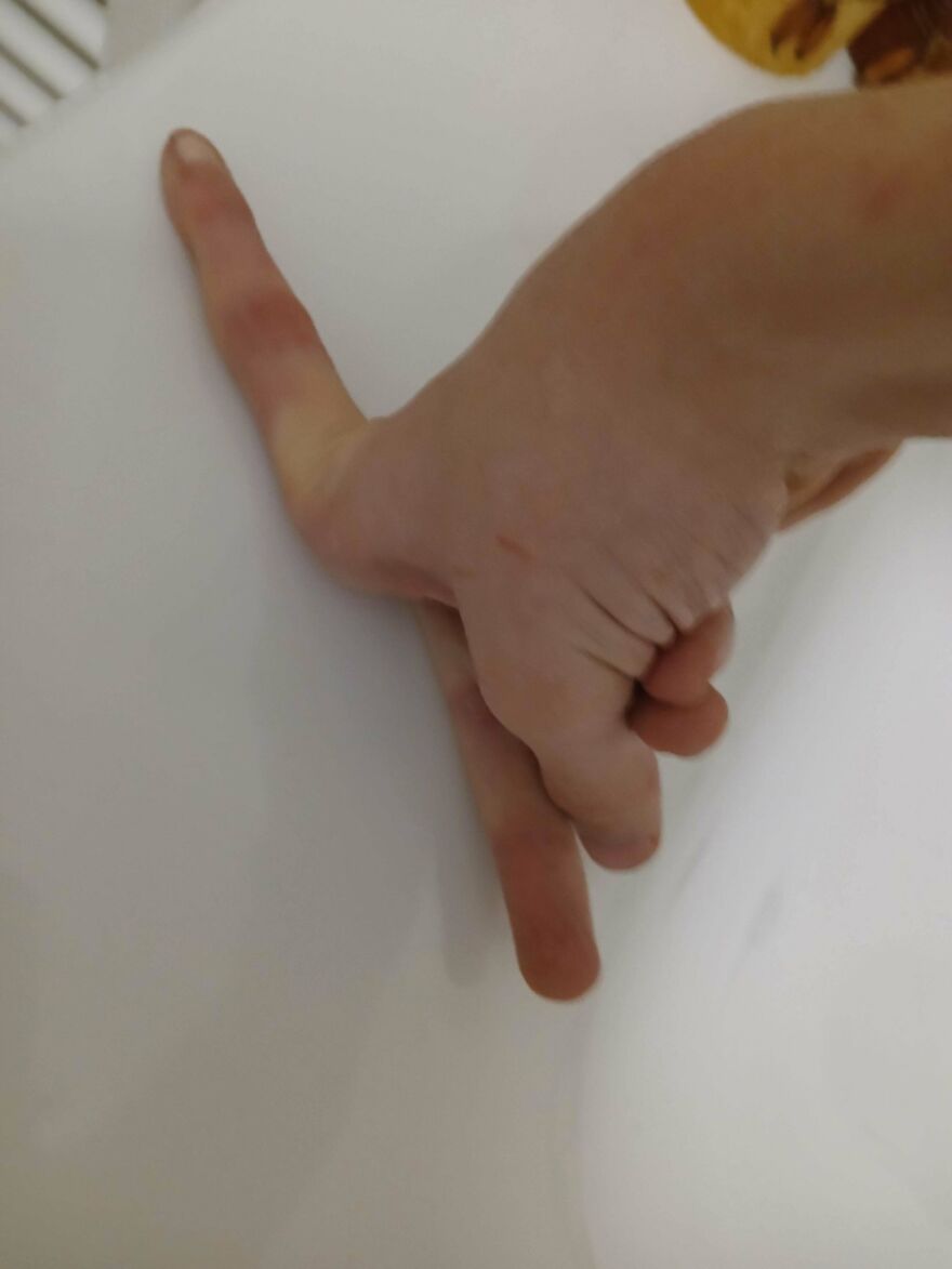 Close-up of a hand showing an unusual finger formation, one finger bent backward in a weird and unexplainable way.
