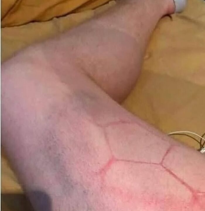 Leg with unusual red markings showing an abnormal skin condition, medical image related to green hairy tongue caution.