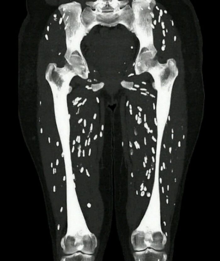 CT scan showing multiple small bright spots scattered throughout thigh muscles, related to medical images involving green hairy tongue.