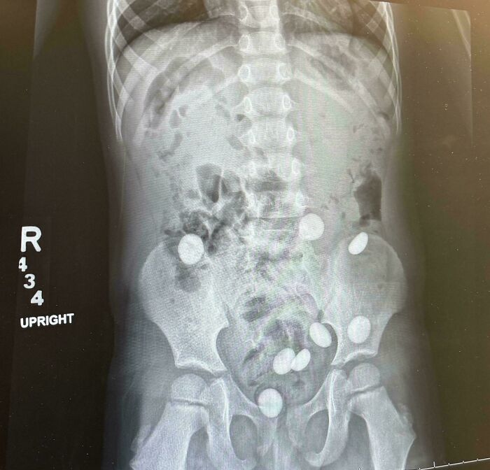 X-ray showing multiple foreign objects inside the abdomen, illustrating unreal photos that reveal incredible aspects of reality.