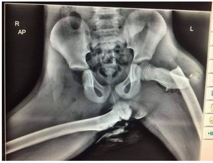 X-ray image showing a severe hip fracture as a result of a disaster where people forgot to think about what could go wrong.