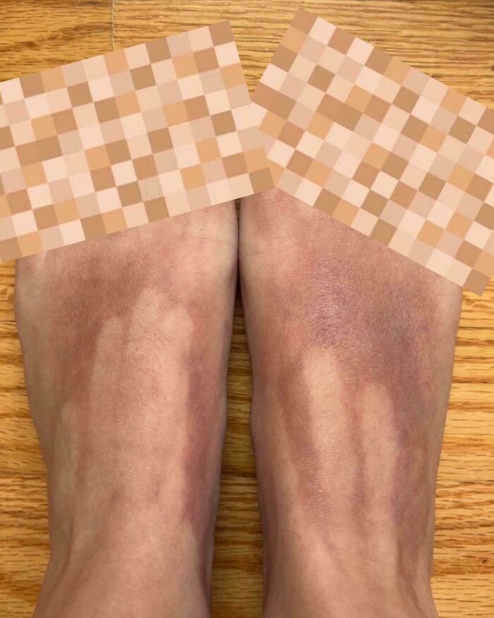 Feet with unusual tan lines showing a clear disaster from forgetting to think about what could go wrong.