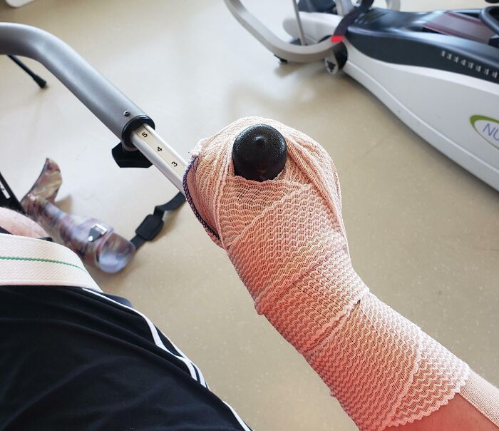 Prosthetic hand with a makeshift attachment gripping an exercise machine handle, illustrating a technically works solution.