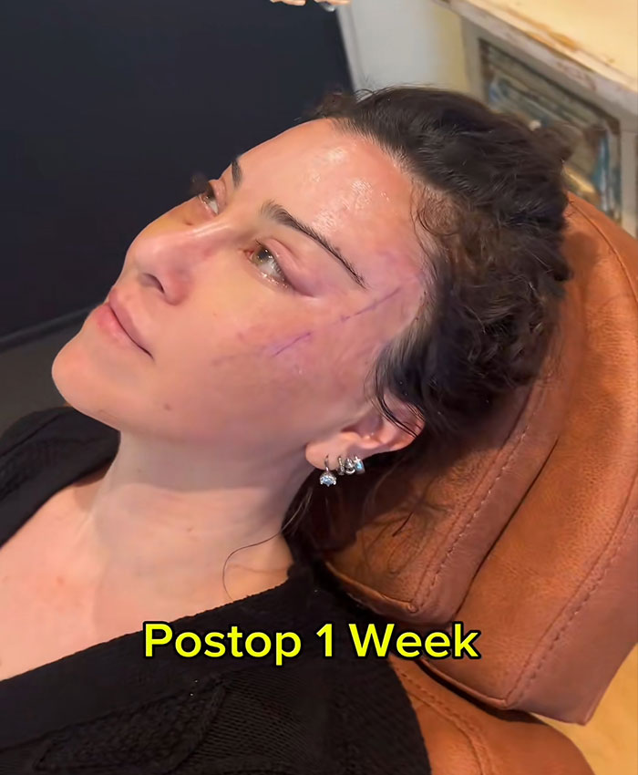 Woman resting in a chair one week postop after a cosmetic procedure with visible healing marks on her face.