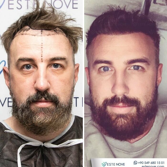 Before and after photos showing hair transplant results on a man with improved hairline and fuller hair restoration.