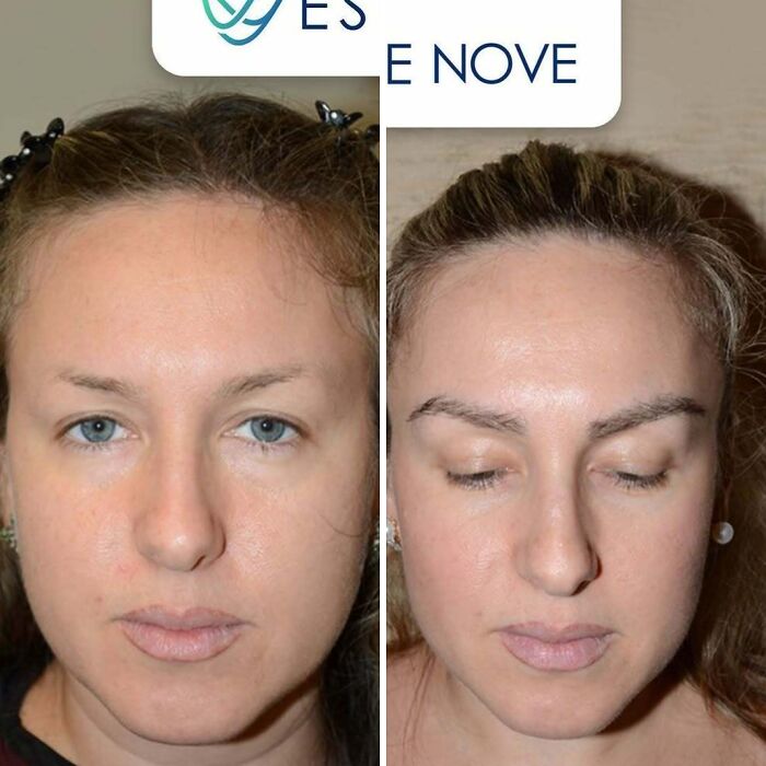 Before and after hair transplant results on a woman showing the effectiveness of professional hair transplant surgery.