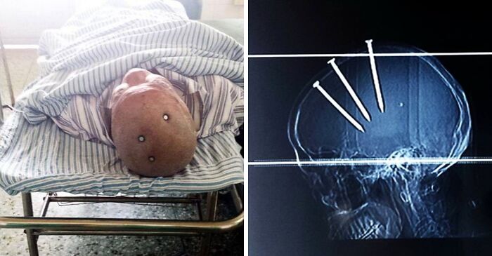 Patient lying on hospital bed with metal implants in head, alongside an X-ray showing nails lodged in a skull - unusual medical photos.