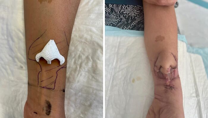Close-up of unusual medical photos showing a forearm with a prosthetic nose and surgical markings on skin.