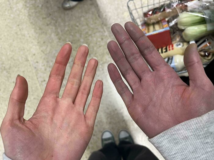 Right Hand Turned Purple After Carrying A Shopping Basket Around The Supermarket