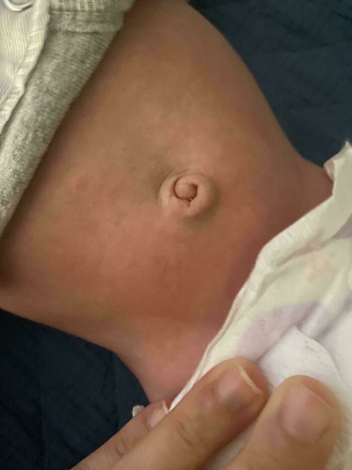 My Newborn Son Has A Swirly Belly Button