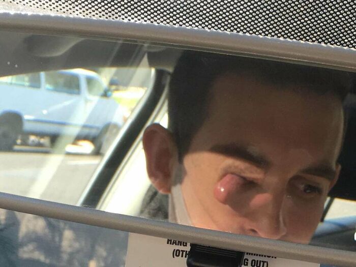 Man with a strange unedited swollen eye condition reflected in a car rearview mirror, a photo that might mess with your brain.