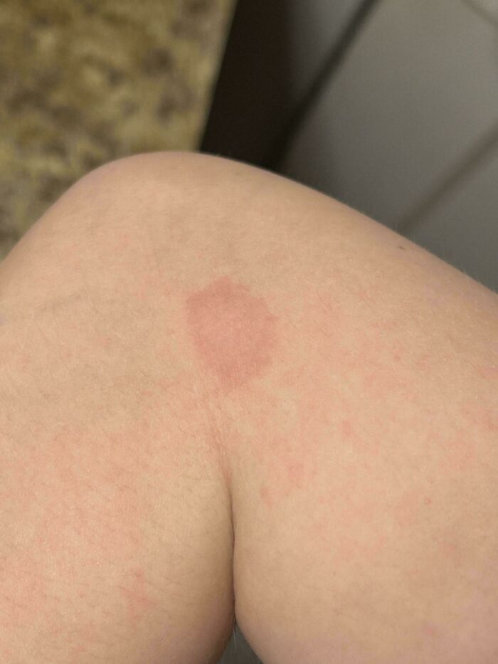 Red Spot Shows Up On My Arm After Every Shower I Take