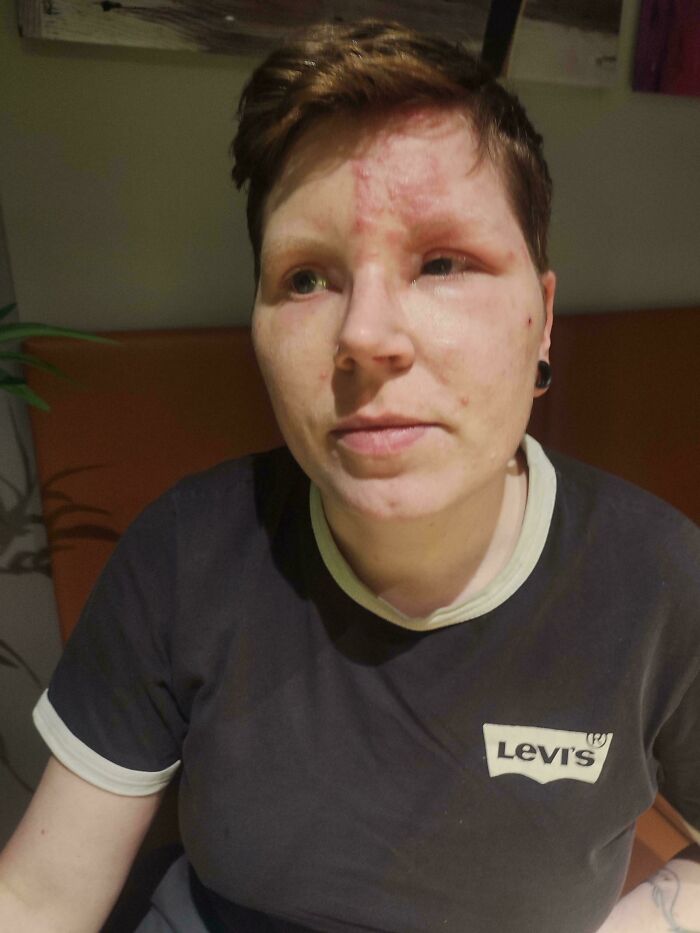 I've Got Shingles Only On Half My Face And One Eye