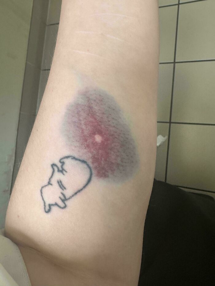 The Bruising On My Arm After A Blood Test Doesn’t Include The Injection Site