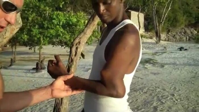 A Haitian Child, Who's Broken Arm Was Left Untreated